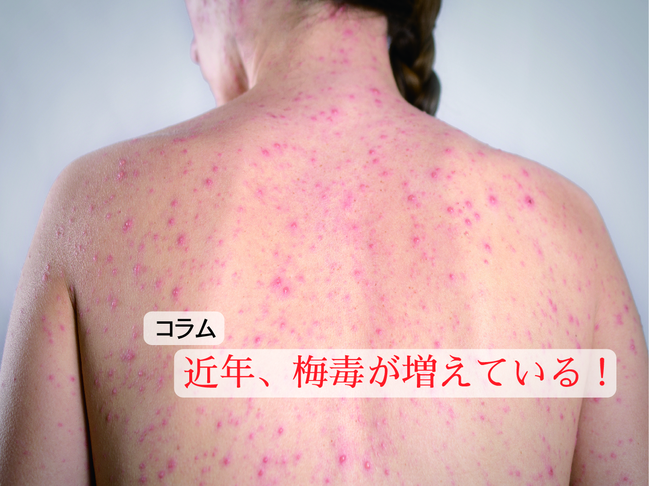 近年、梅毒が増えている！